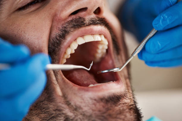 Best Emergency Dentist for Lost Fillings or Crowns in North Kansas City, MO