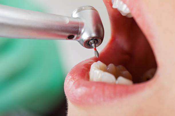 Best Emergency Root Canal Treatment in North Kansas City, MO